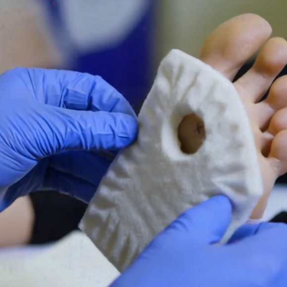 Chiropody felt being applied around a corn for pressure redistribution