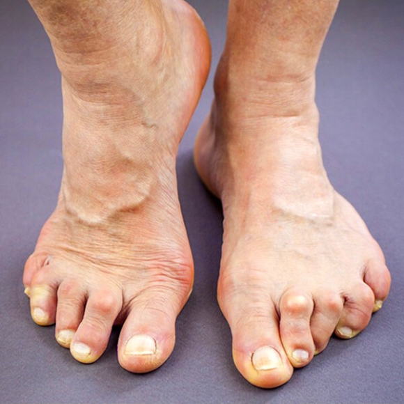 Arthritis Aids for Joint Pain Relief