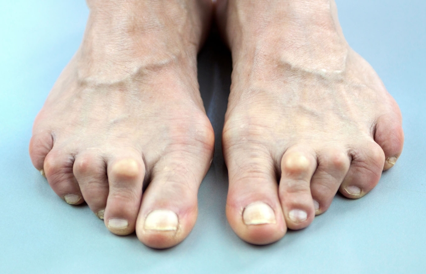 Rheumatoid Arthritis Of the Foot