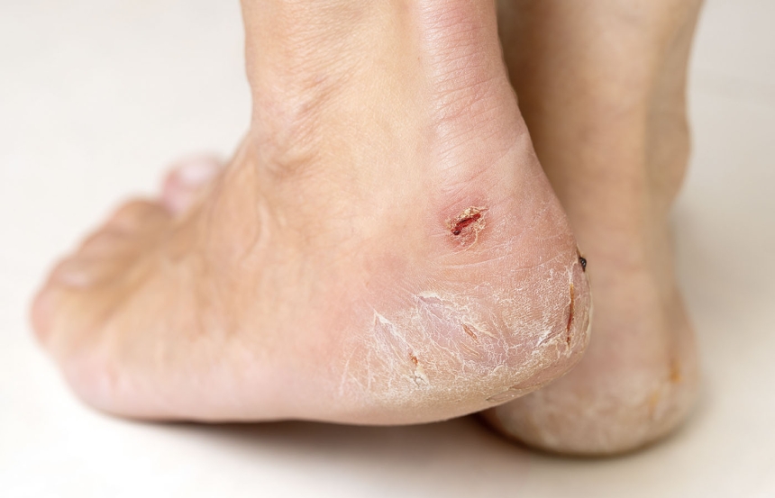 Painful Cracked Heels