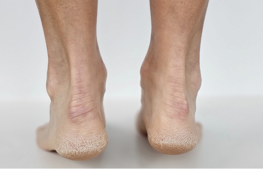 Cracked Heels