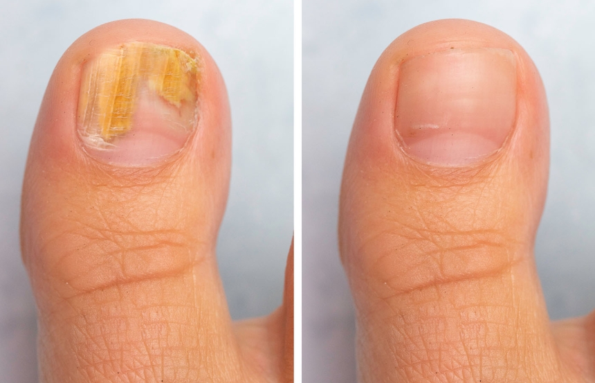 Fungal Nail - Before and After