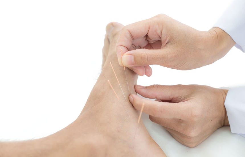 Acupuncture for Plantar Fasciitis