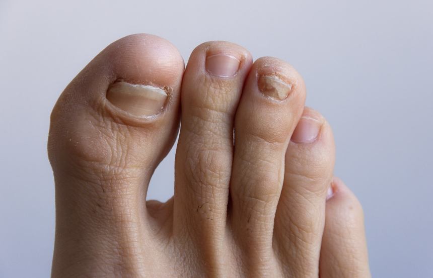 Hammertoe