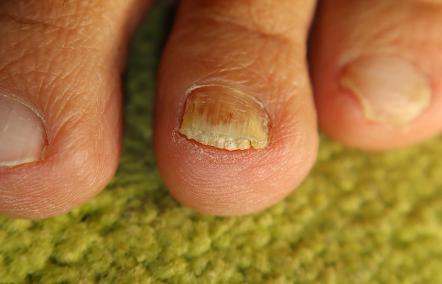 Fungal Nail Infection