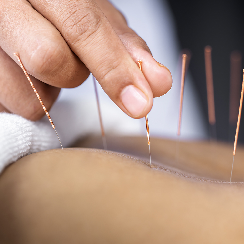 Acupuncture Supplies