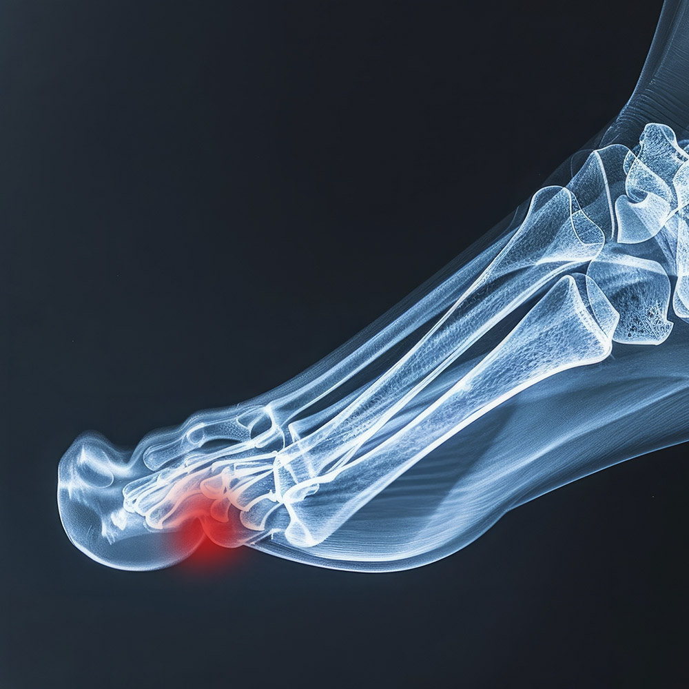 Turf Toe Treatment Solutions