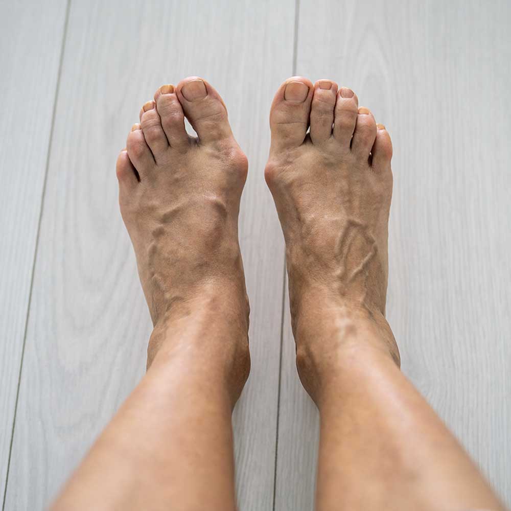 Arthritis Insoles and Foot Care Solutions