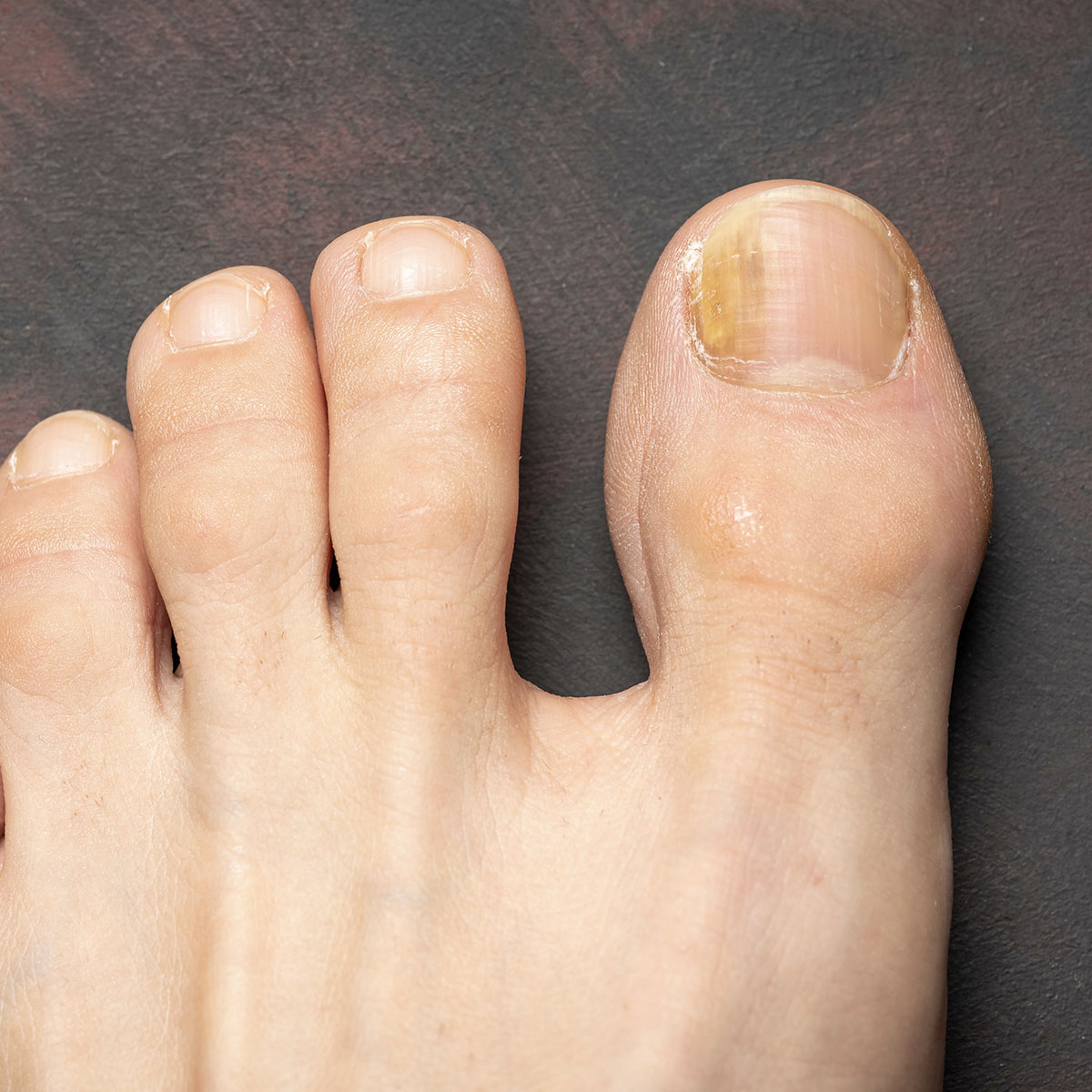 Fungal Nail Treatments UK