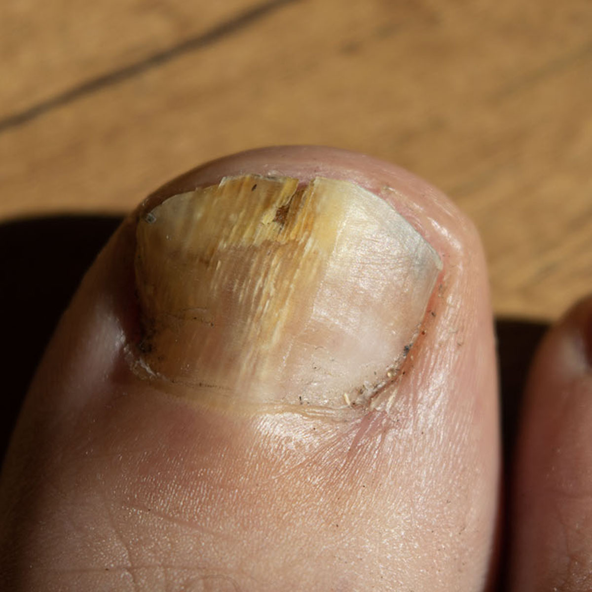Fungal Toenail Treatments