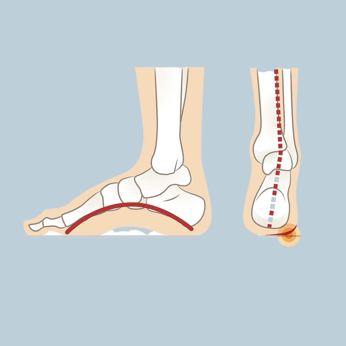 High Arches (Pes Cavus) Insoles
