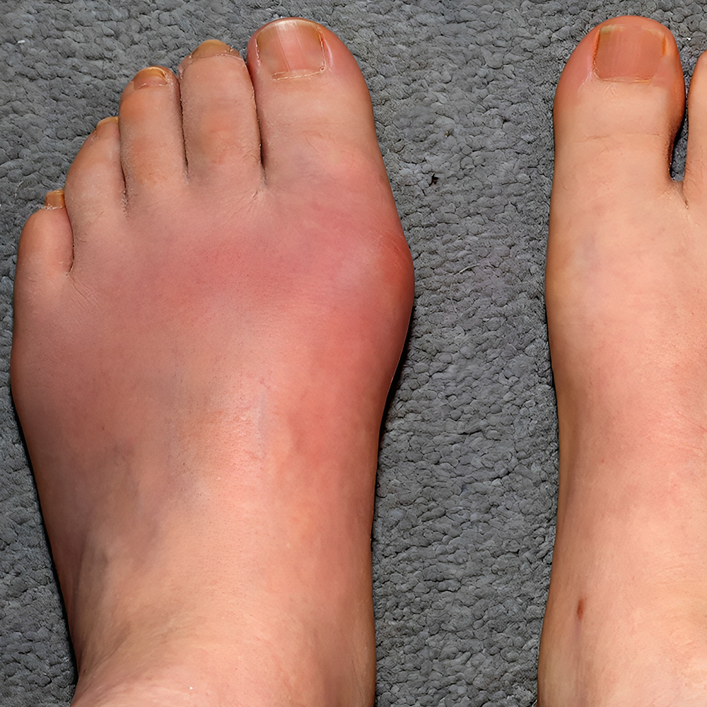Lower Limb Gout Management Aids