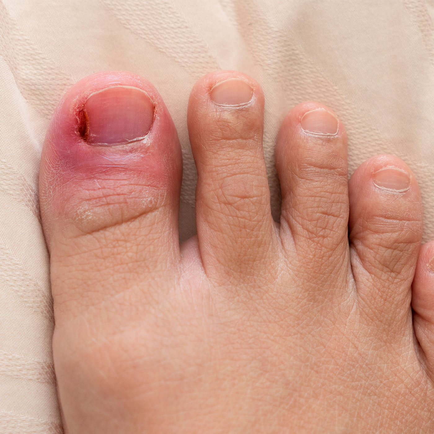 Ingrown Toe Nail Treatment
