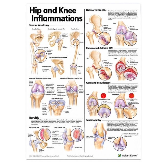 Hip and Knee Inflammations Anatomical Poster