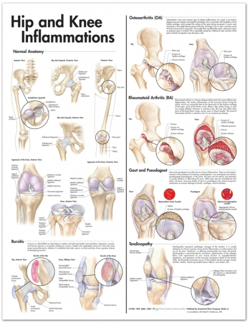 Hip and Knee Inflammations Anatomical Poster