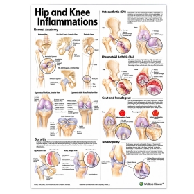 Hip and Knee Inflammations Anatomical Poster