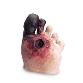 Diabetic Foot Model