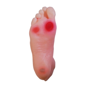 Diabetic Foot Model - Educational Tool for Clinics and Patients