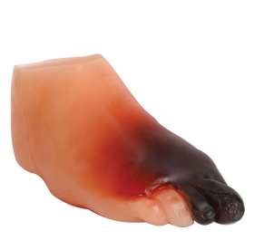 Severe Diabetic Foot Model