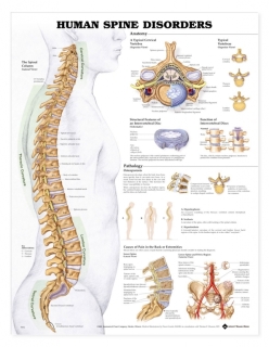 Human Spine Disorders Anatomical Chart | L50 x 66cm - Heavy Paper laminated with Grommets. 