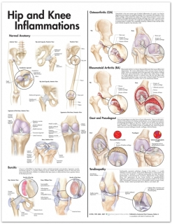 Hip and Knee Inflammations Anatomical Poster | Colour chart