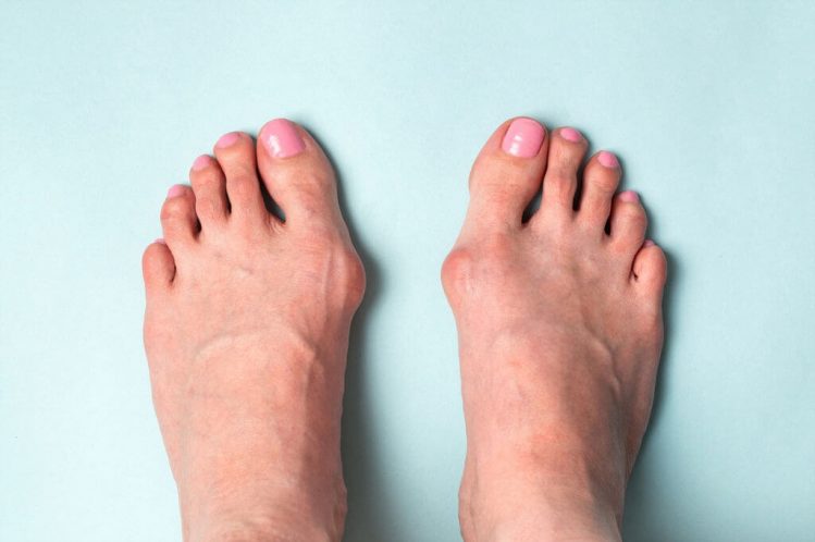 Arthritis in Feet