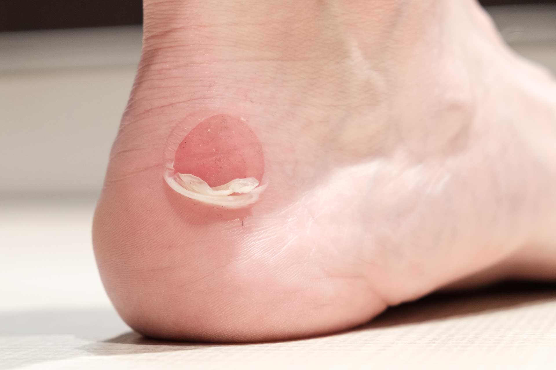 Foot Blisters - Very Annoying!