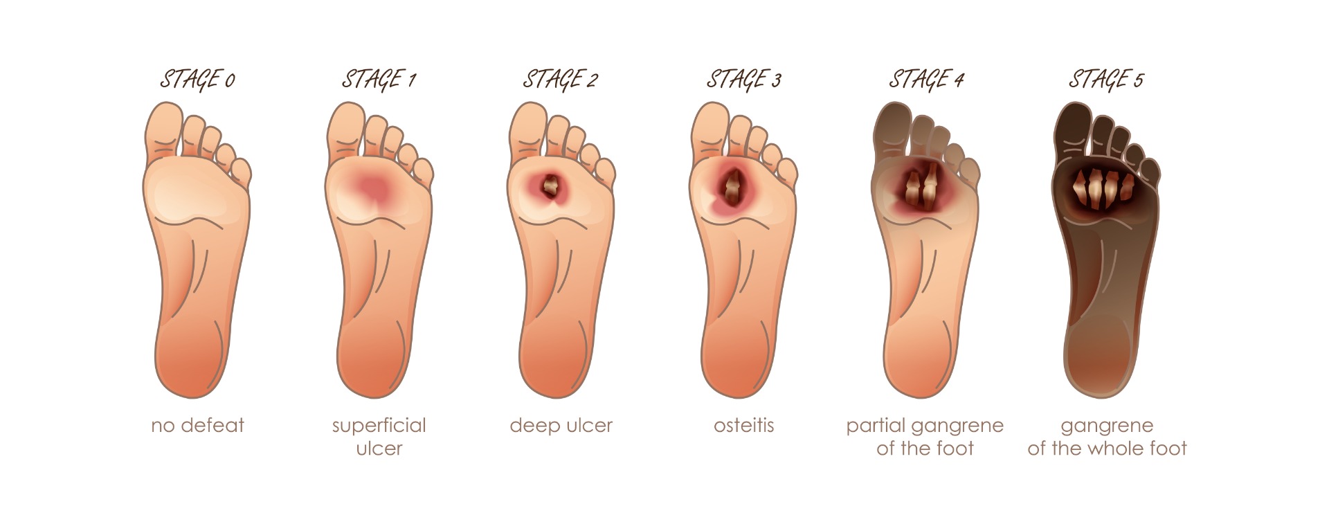 Diabetic Foot Stages