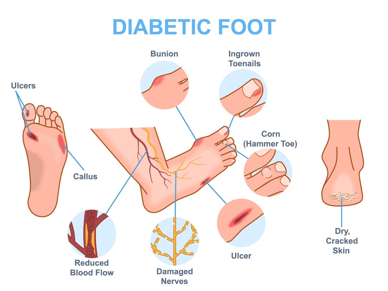 Diabetic Feet