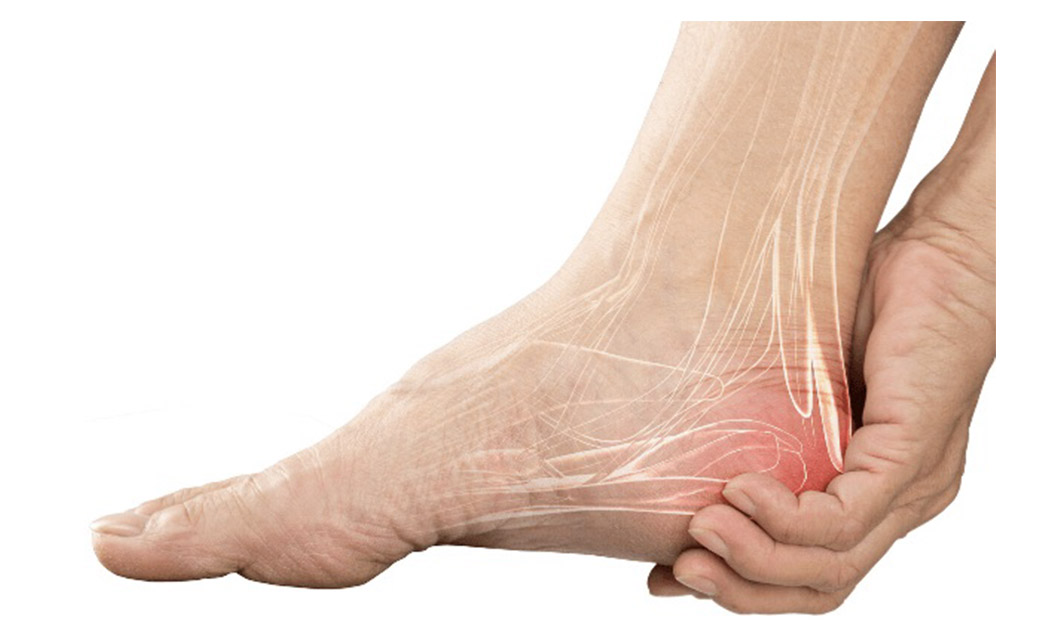 What is Heel pain Bursitis & Plantar Fasciitis Algeos