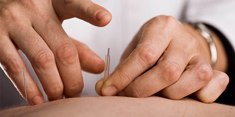 Guide Tube Acupuncture