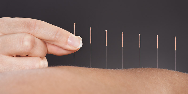 Acupuncture Needles on Back