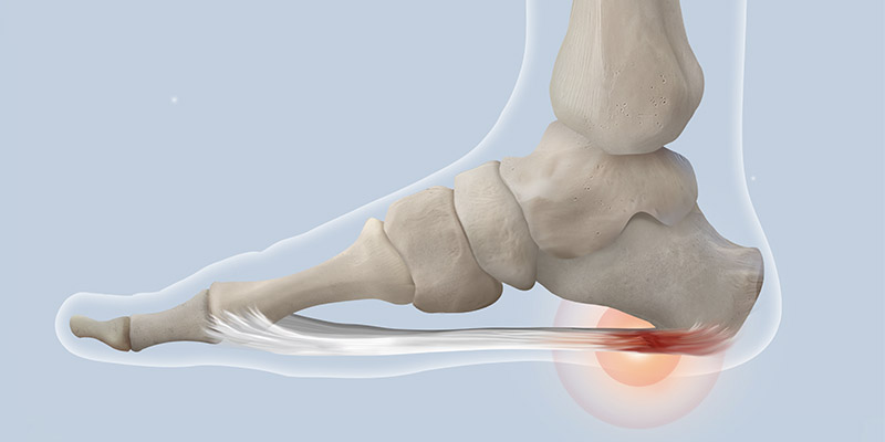 Plantar Fasciitis Research