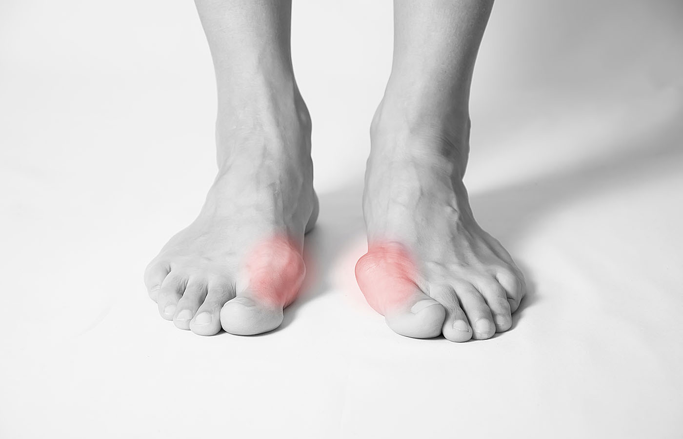 Bunion