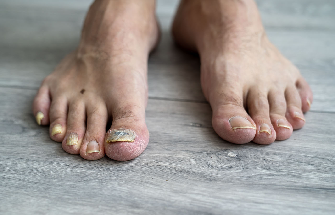 Fungal Nail