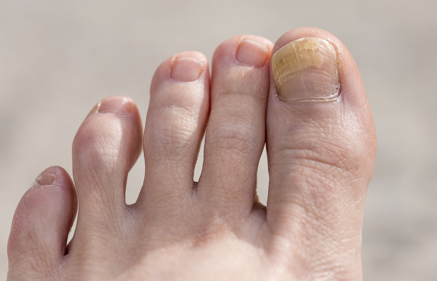Fungal Nail Infection