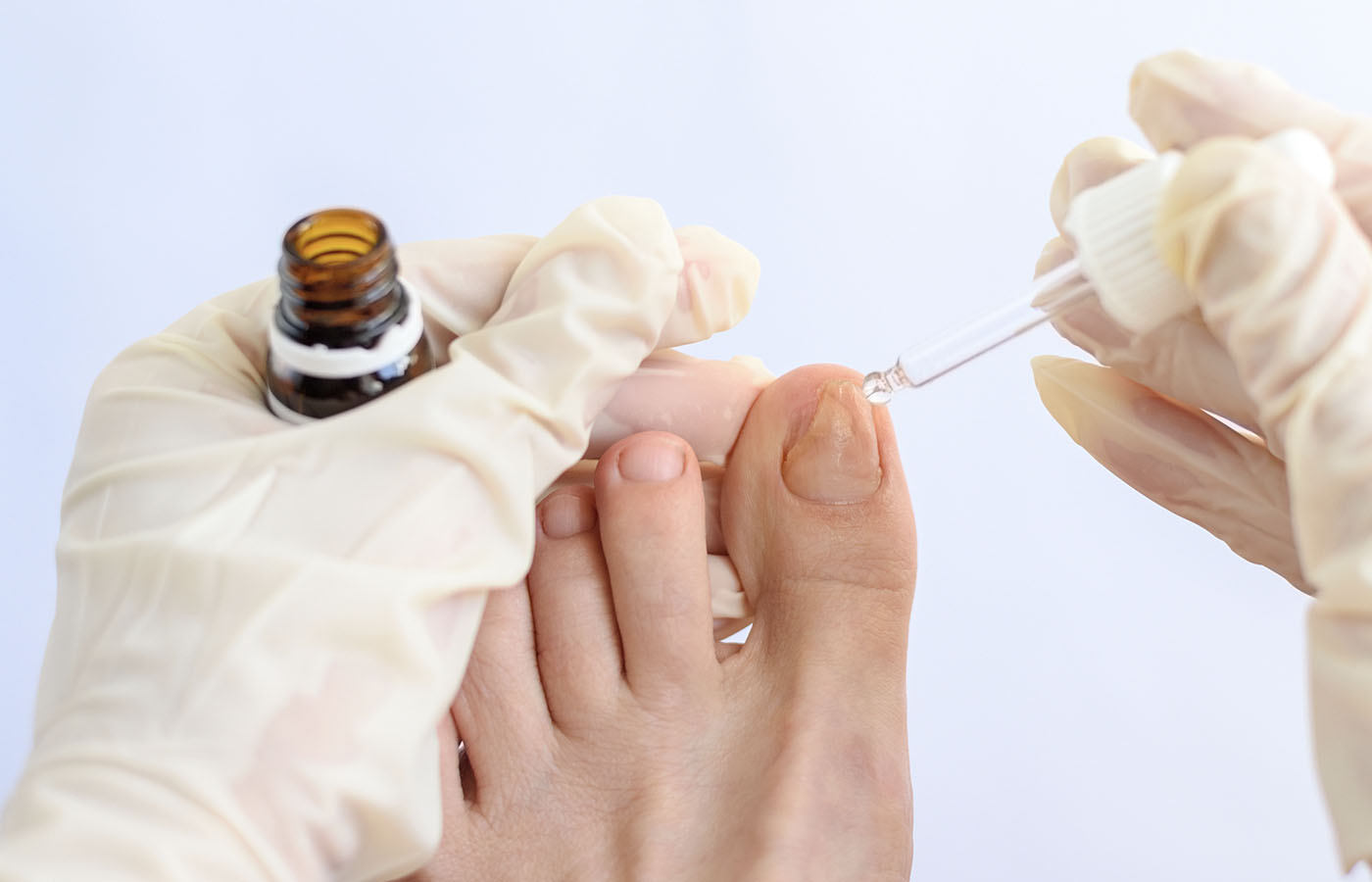 Fungal Nail Prevention