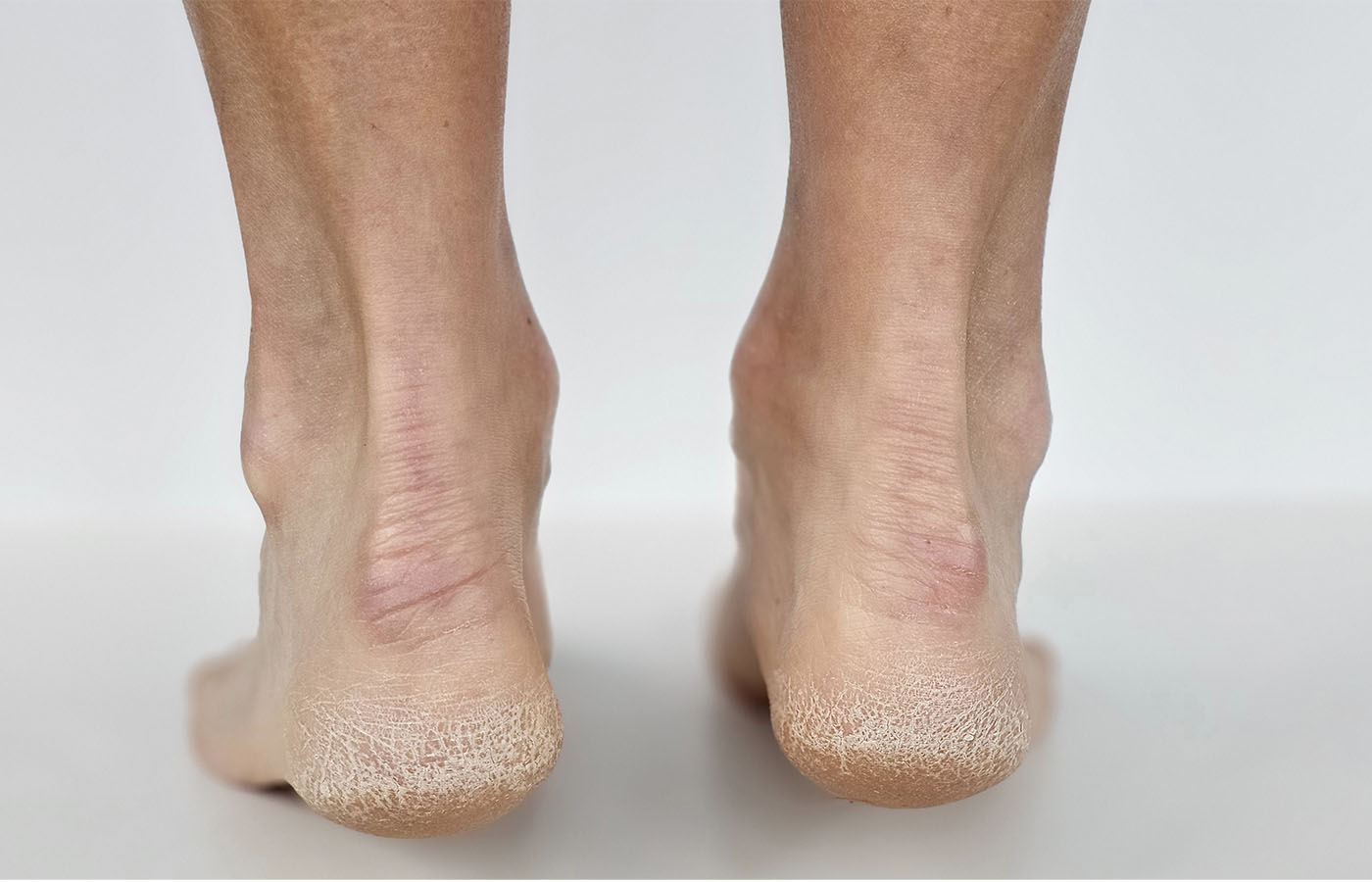 Cracked Heels