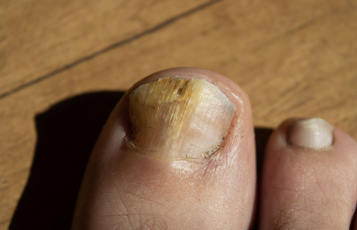 Fungal Nail Infection