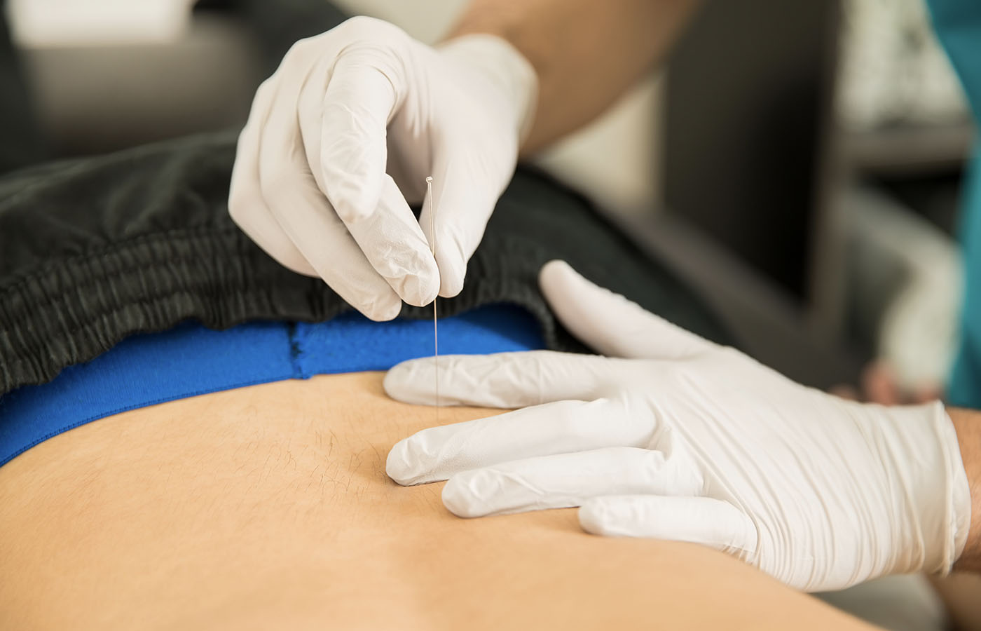 Acupuncture in the NHS