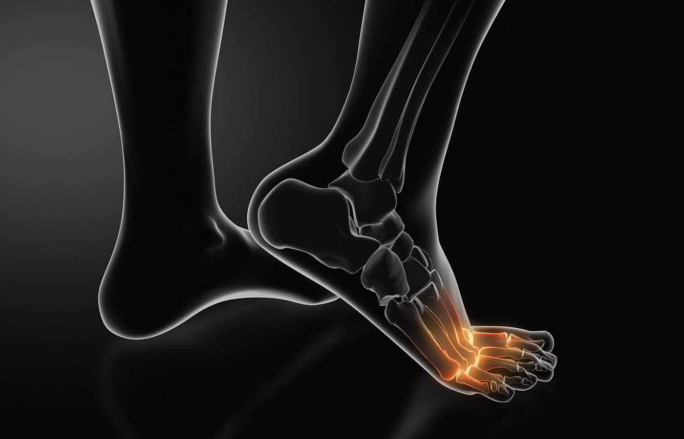 Treating Metatarsalgia