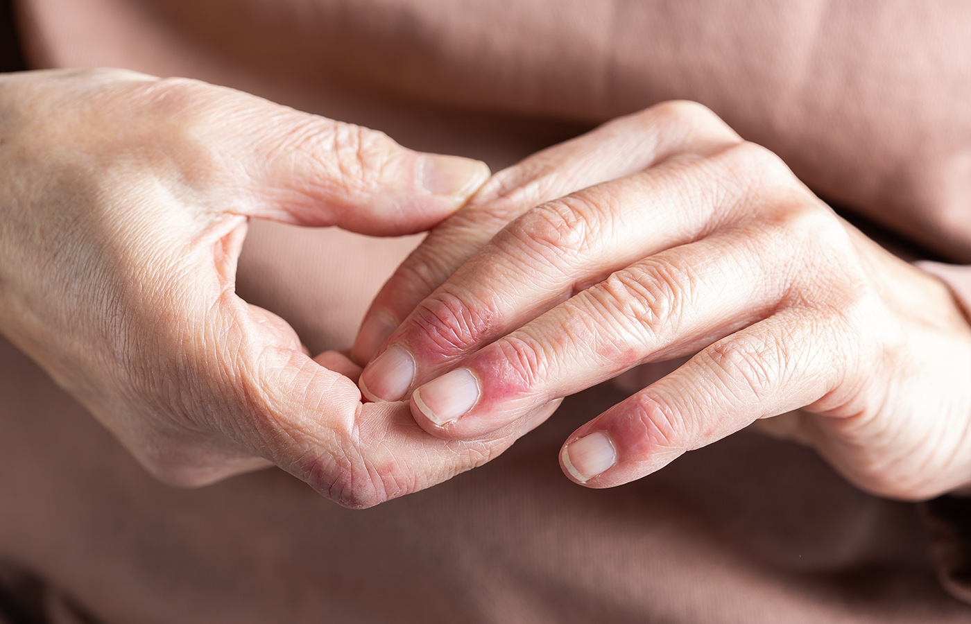 Dry Sore Hands