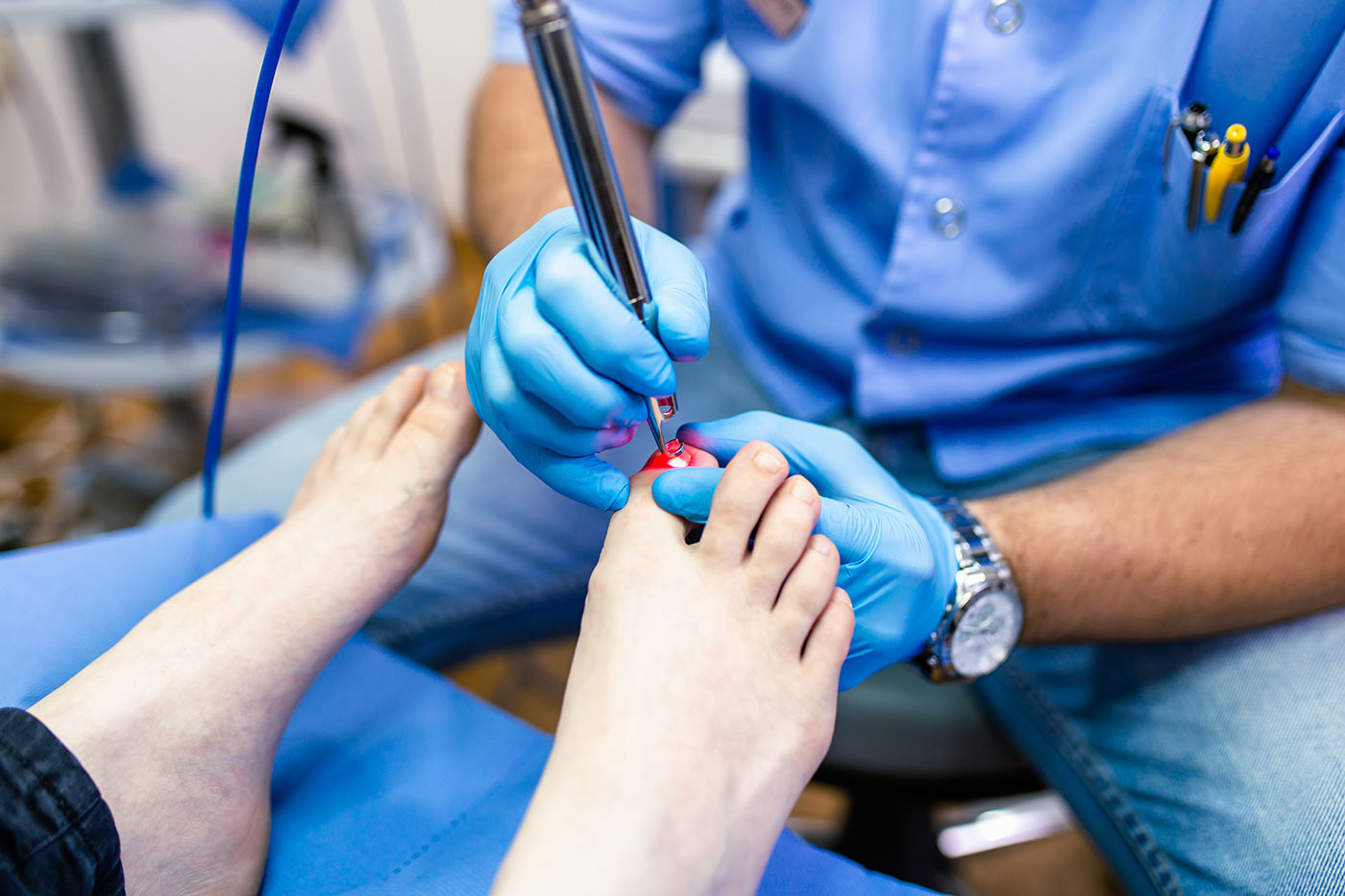 Fungal Nail Laser