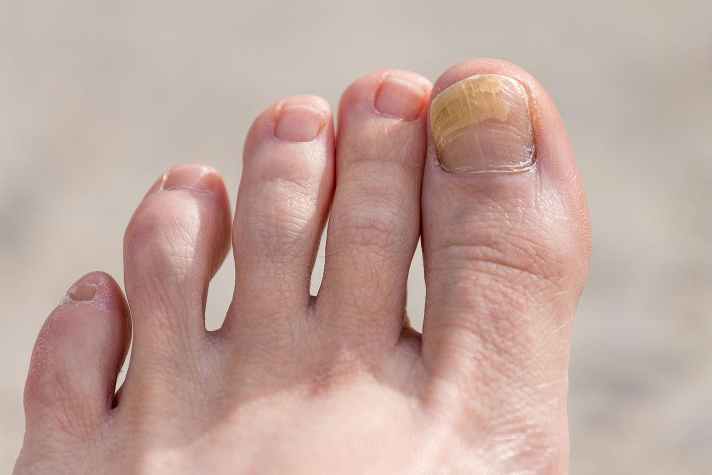 Fungal Nail