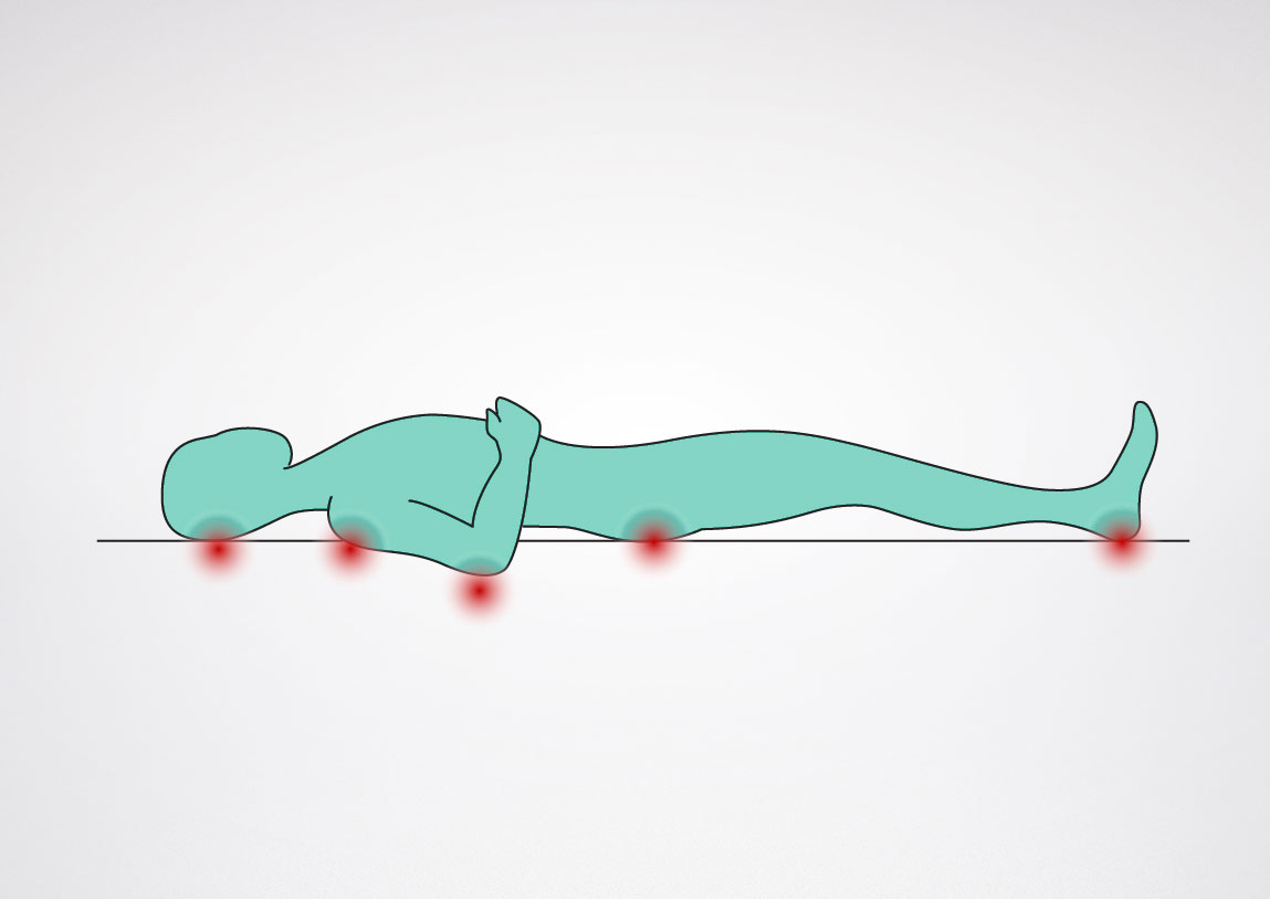 Pressure Ulcers Areas
