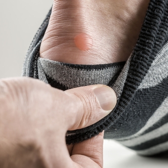 Foot Blisters