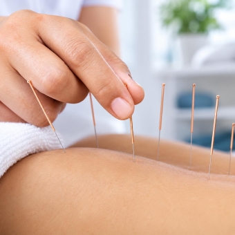 Acupuncture Supplies