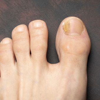 Fungal Nail