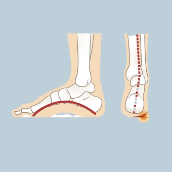High Arches (Pes Cavus) Insoles