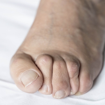 Hammer Toes